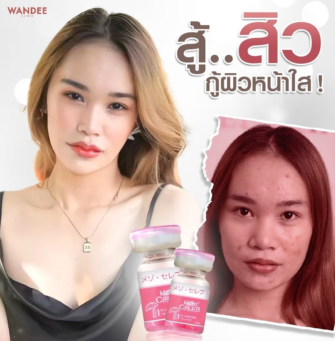 ฉีดเมโสหน้าใส