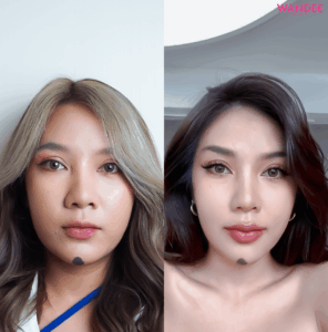 Restylane filler 2024