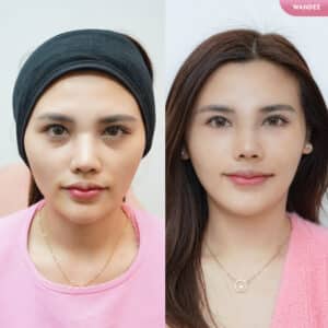 Restylane filler 2024