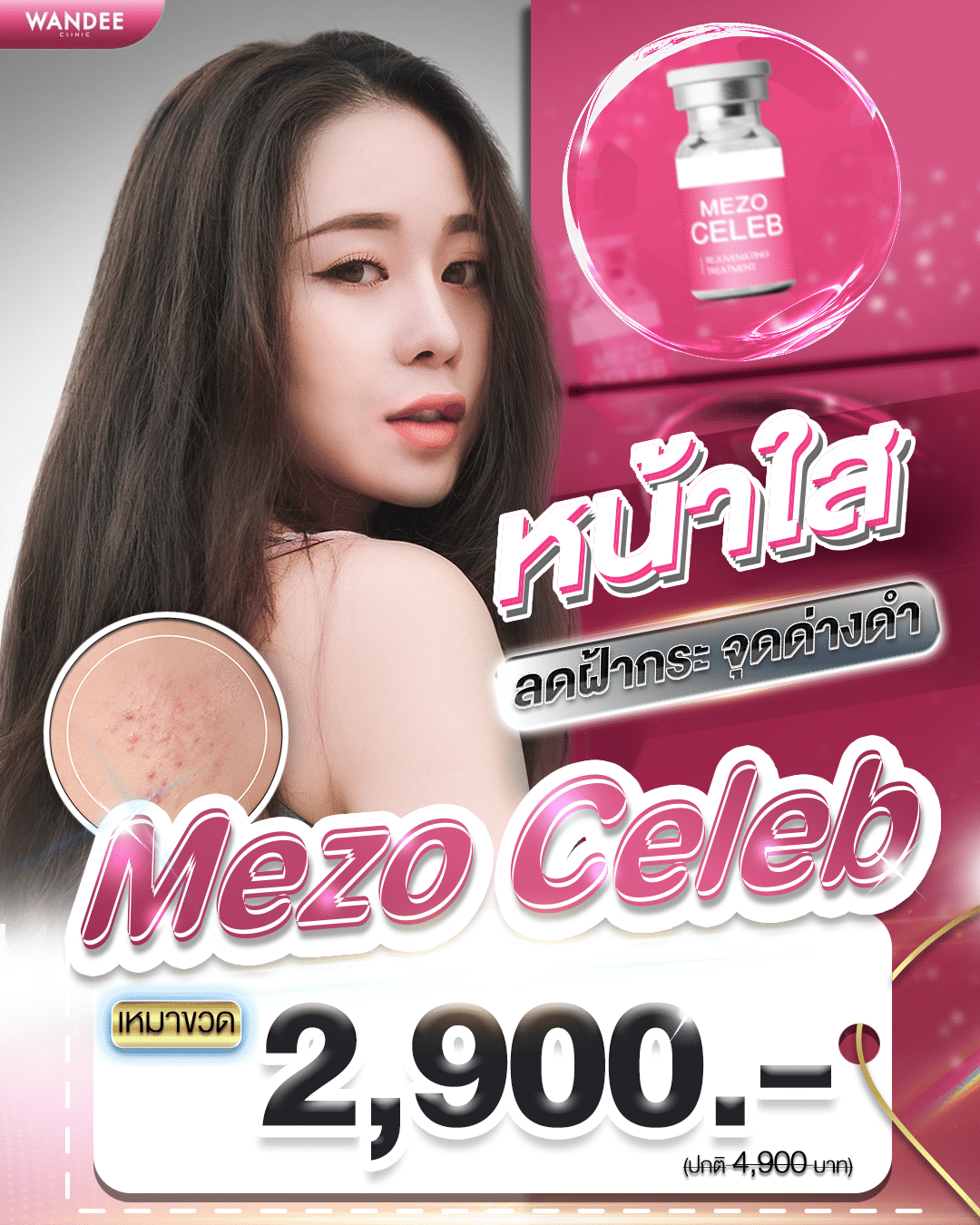ราคาเมโส หน้าใส Wandee Clinic
