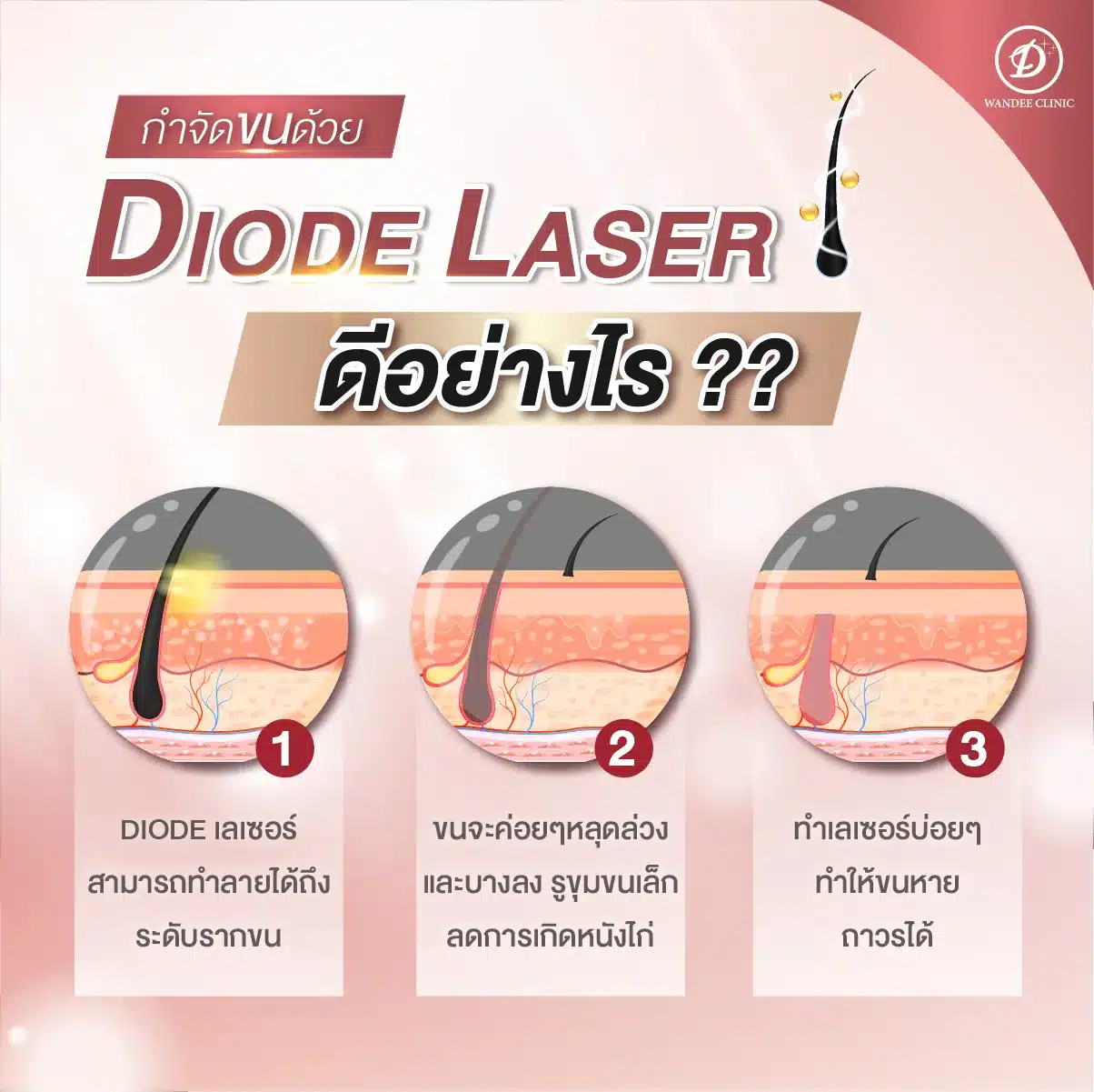 คลินิกเลเซอร์กำจัดขนพัทยาที่ดีที่สุด ไม่เจ็บ ไม่อันตราย