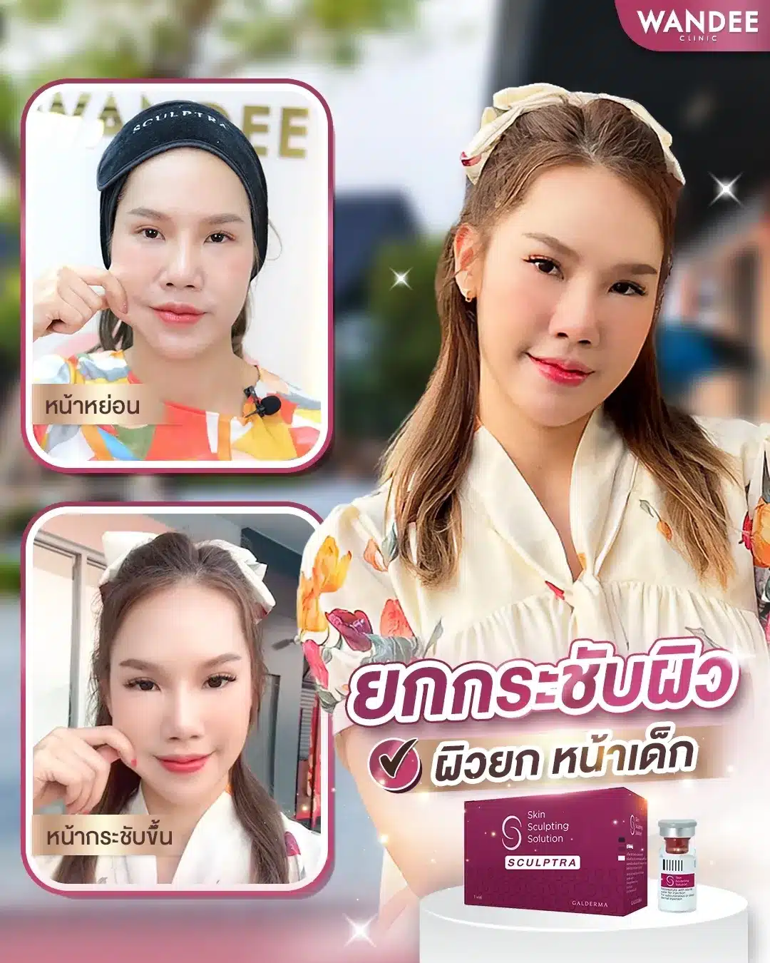 sculptra พัทยา ฉีดแล้วดีไหม? นวัตกรรมฟื้นฟูผิว ย้อนวัยไปอีก 10 ปี!