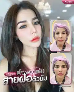 เติมฟิลเลอร์ร่องแก้ม พัทยา ชลบุรี ที่ไหนดี? หัตถการปรับหน้าเด็ก