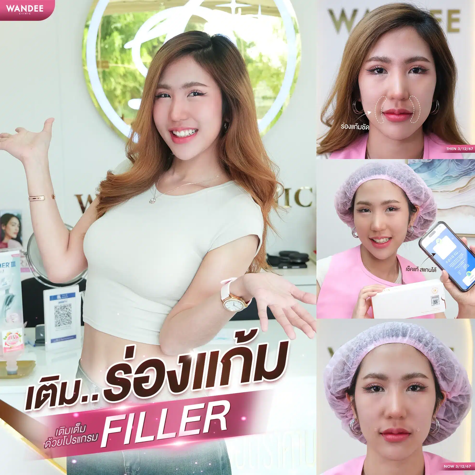 เติมฟิลเลอร์ร่องแก้ม พัทยา ชลบุรี ที่ไหนดี? หัตถการปรับหน้าเด็ก