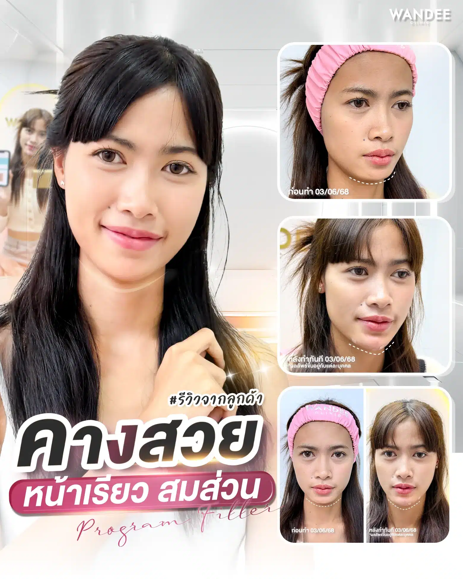 รีวิว ฟิลเลอร์คาง Wandee Clinic