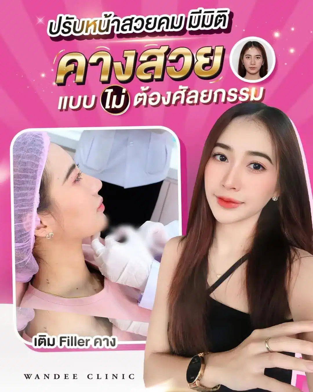 รีวิว ฟิลเลอร์คาง Wandee Clinic