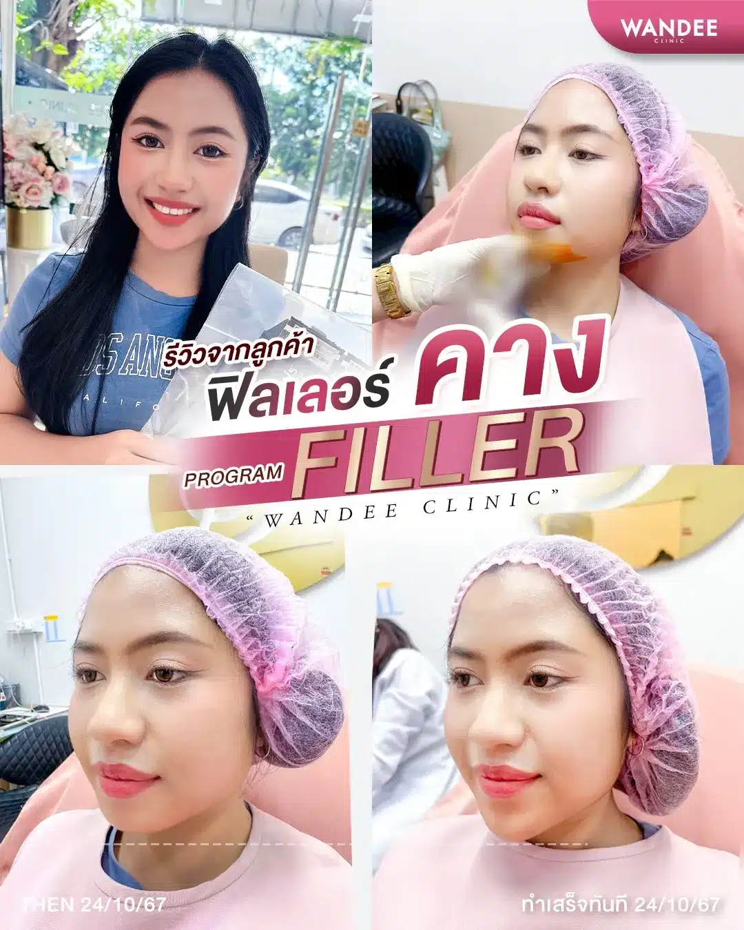 รีวิว ฟิลเลอร์คาง Wandee Clinic