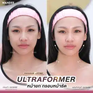 รีวิว ultraformer Wandee Clinic