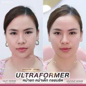 รีวิว ultraformer Wandee Clinic