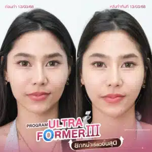 รีวิว ultraformer Wandee Clinic