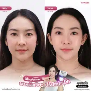 รีวิว ultraformer Wandee Clinic