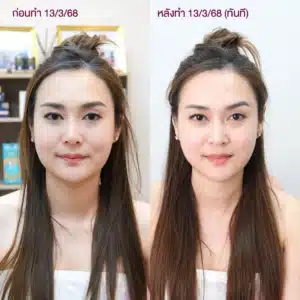 รีวิว ultraformer Wandee Clinic