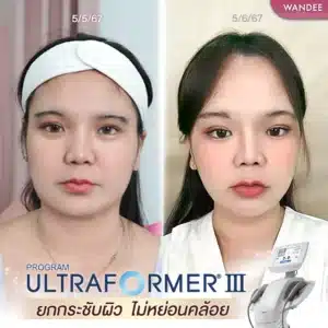รีวิว ultraformer Wandee Clinic