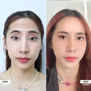 รีวิว Botox Wandee Clinic