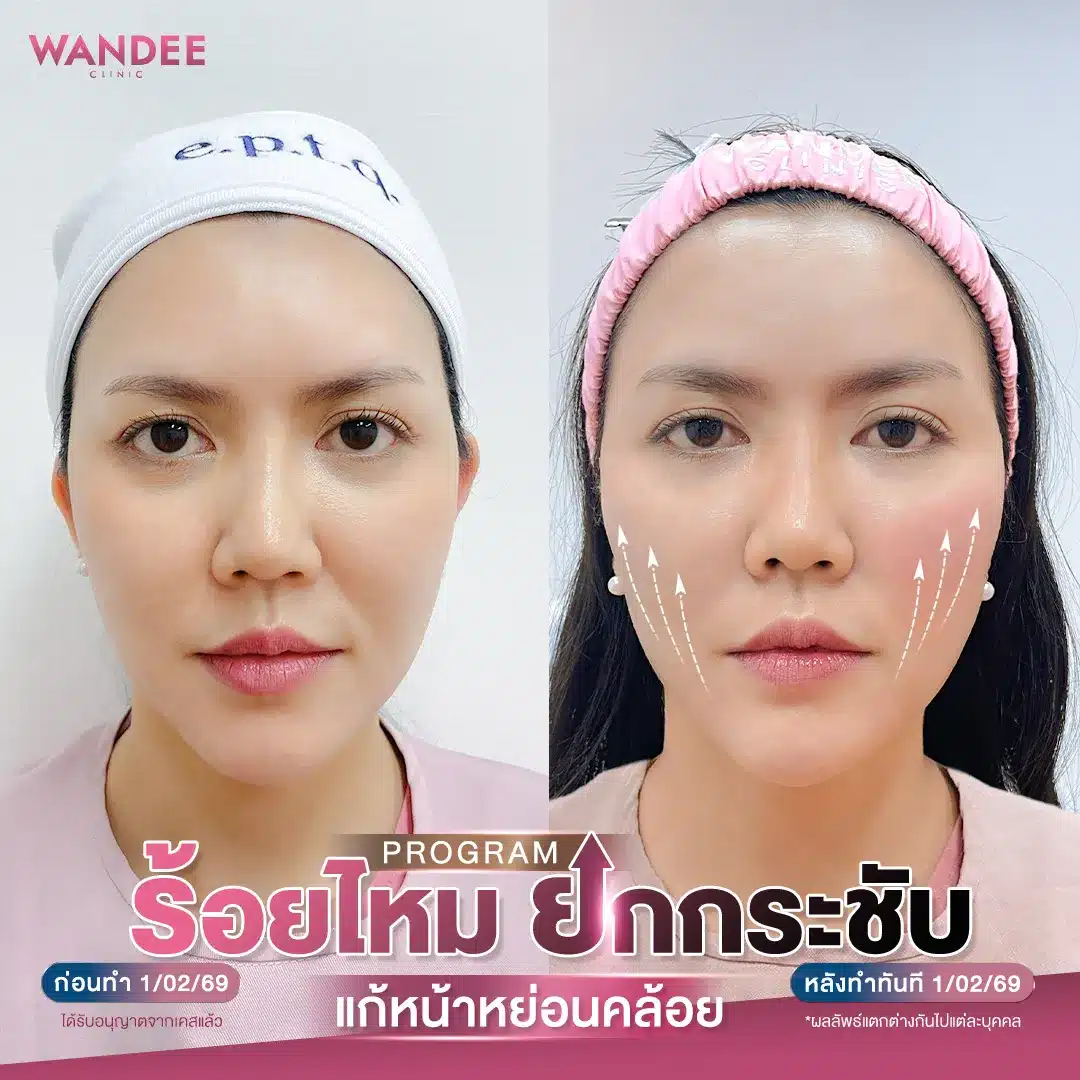 รีวิวร้อยไหม ที่ Wandee Clinic
