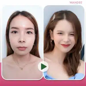 รีวิว Botox Wandee Clinic