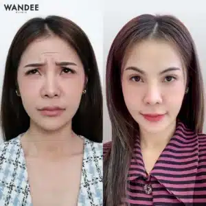 รีวิว Botox Wandee Clinic