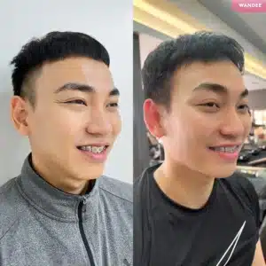 รีวิว Botox Wandee Clinic