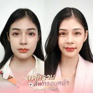 รีวิว Botox Wandee Clinic