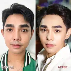 รีวิว Botox Wandee Clinic