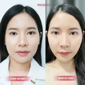 รีวิว Botox Wandee Clinic
