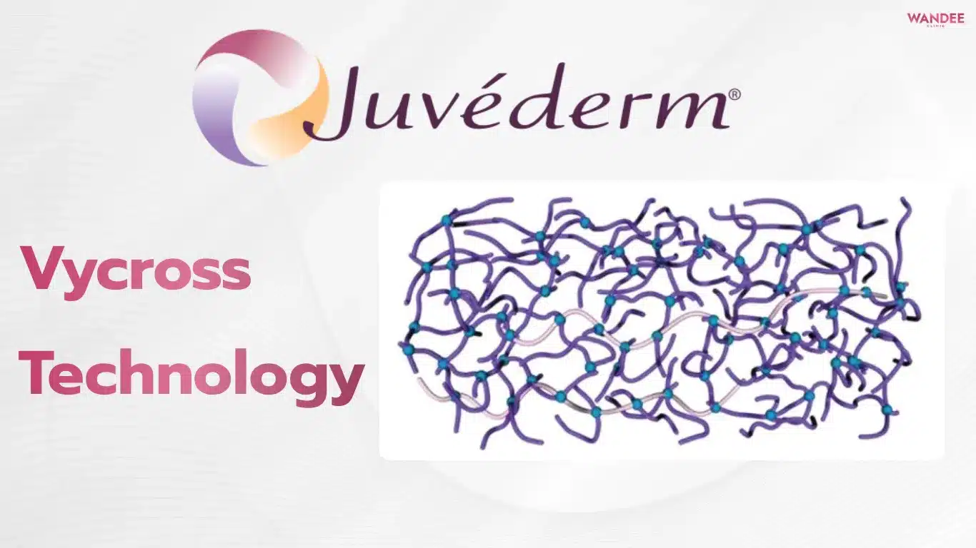 เทคโนโลยี Vycross ฟิลเลอร์ Juvederm
