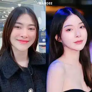 รีวิว Botox Wandee Clinic