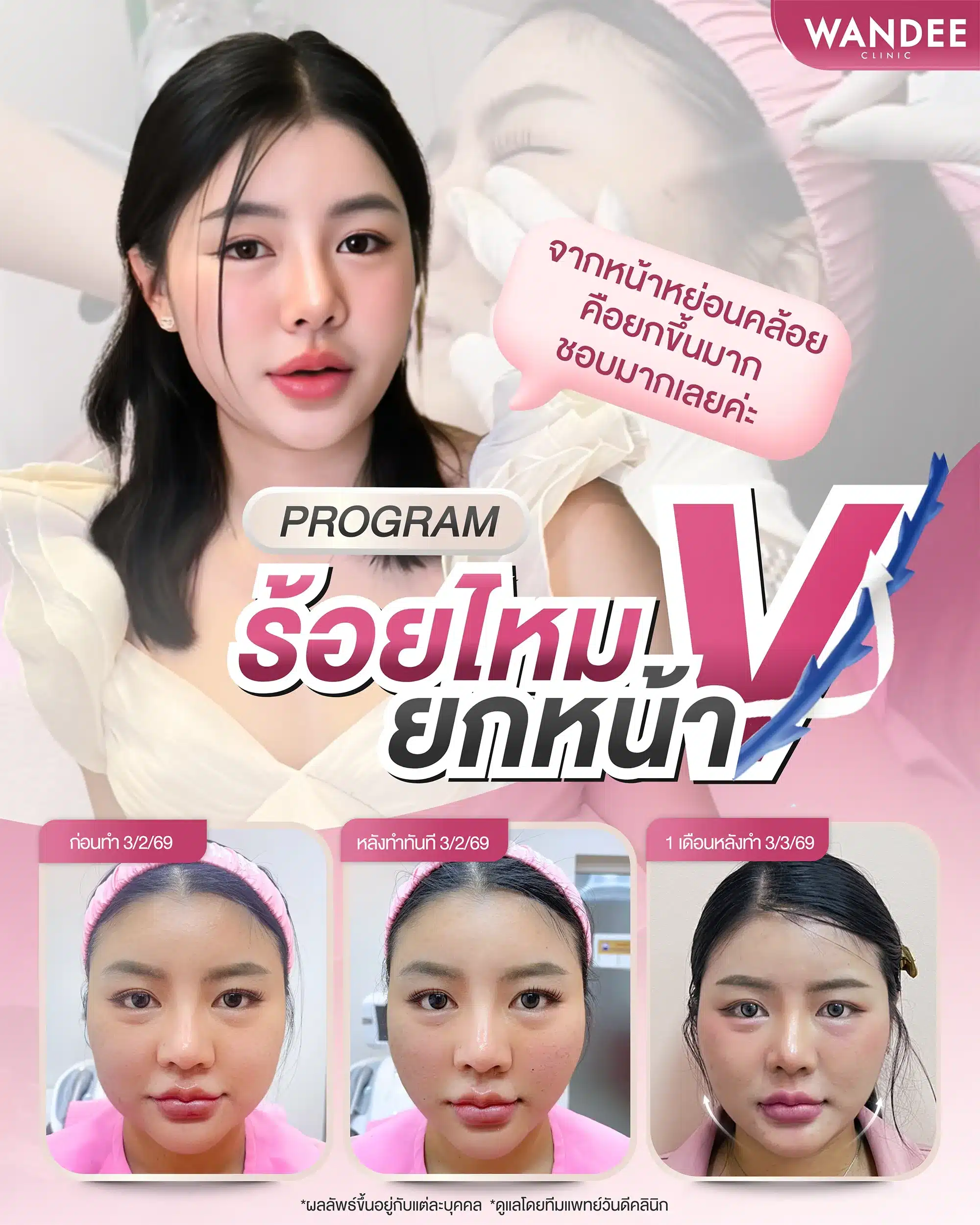 รีวิวร้อยไหม ที่ Wandee Clinic