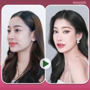 รีวิว Botox Wandee Clinic