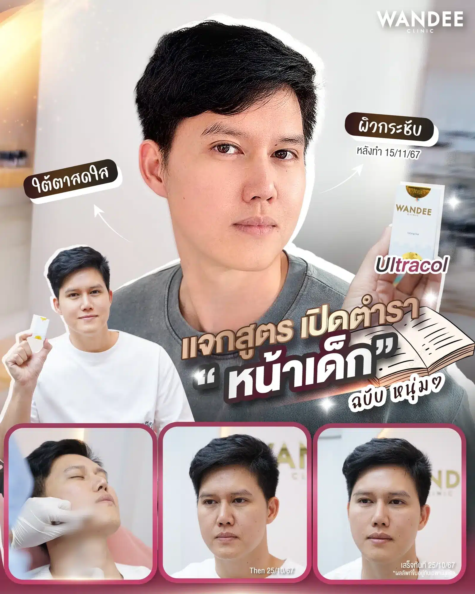 รีวิว Ultracol ที่ Wandee Clinic